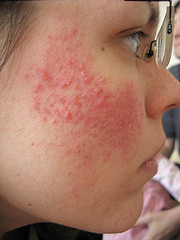 Steroid injection causing rash